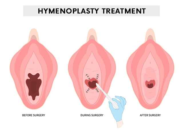 Hymenoplasty