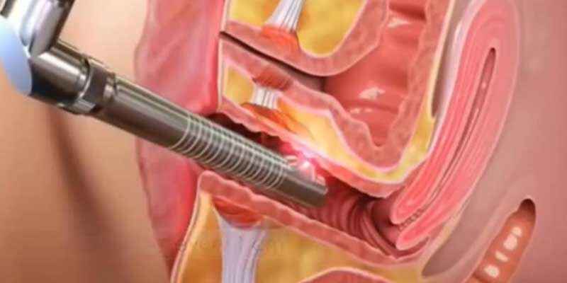 Laser Vaginal Rejuvenation