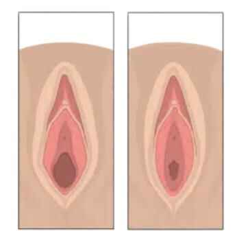 Perineoplasty