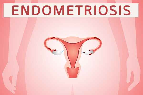 Understanding Endometriosis and Its Effects on Infertility