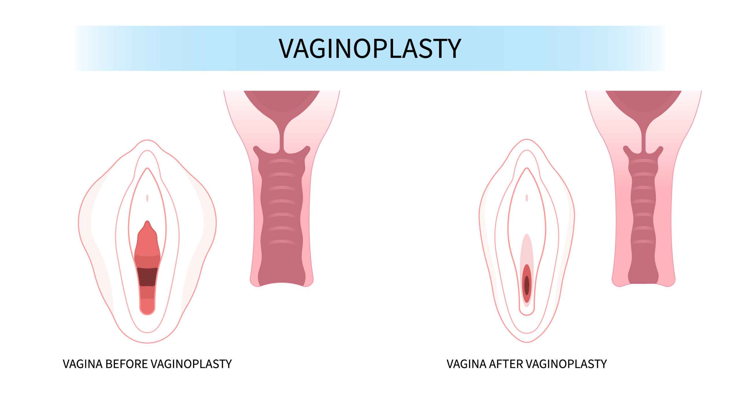 Vaginal Tightening (Vaginoplasty)