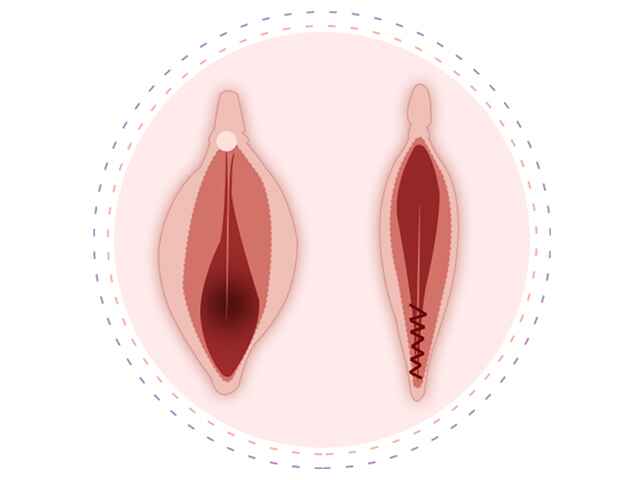 Vulvar Rejuvenation
